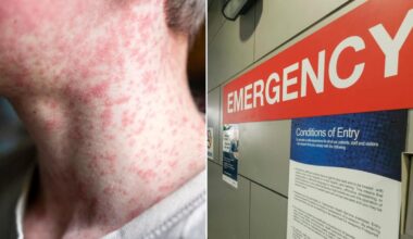 NSW Health confirms measles case in western Sydney with no known source