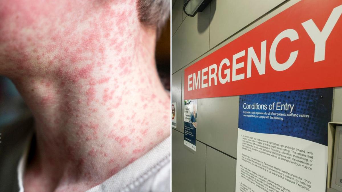NSW Health confirms measles case in western Sydney with no known source