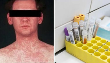 Measles cases confirmed in major urban hub