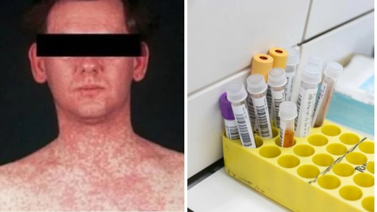 Measles cases confirmed in major urban hub