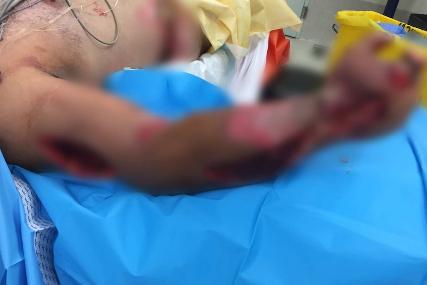 A arm with electric shock wounds on a hospital bed.