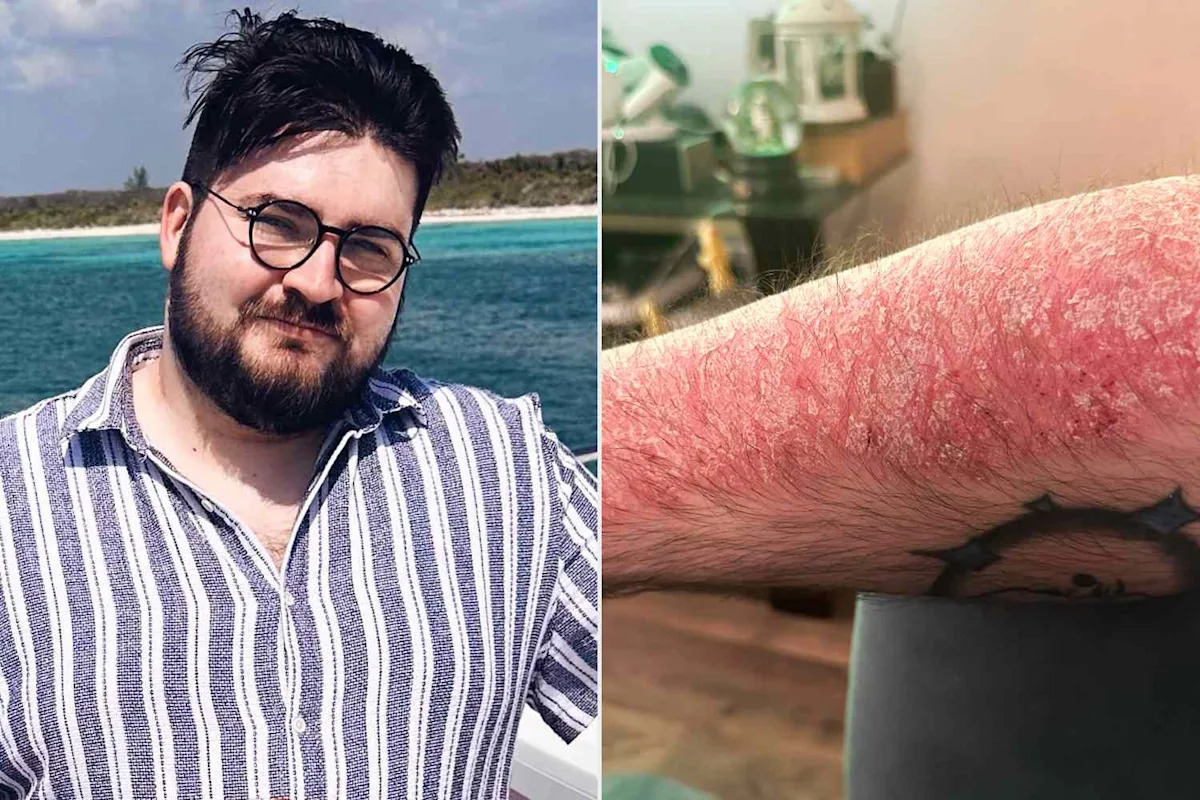 Man Recalls 'Emotional Toll' of Having Psoriasis as a Teen: 'It Was Very Difficult to Live and Be Out in the World' (Exclusive)