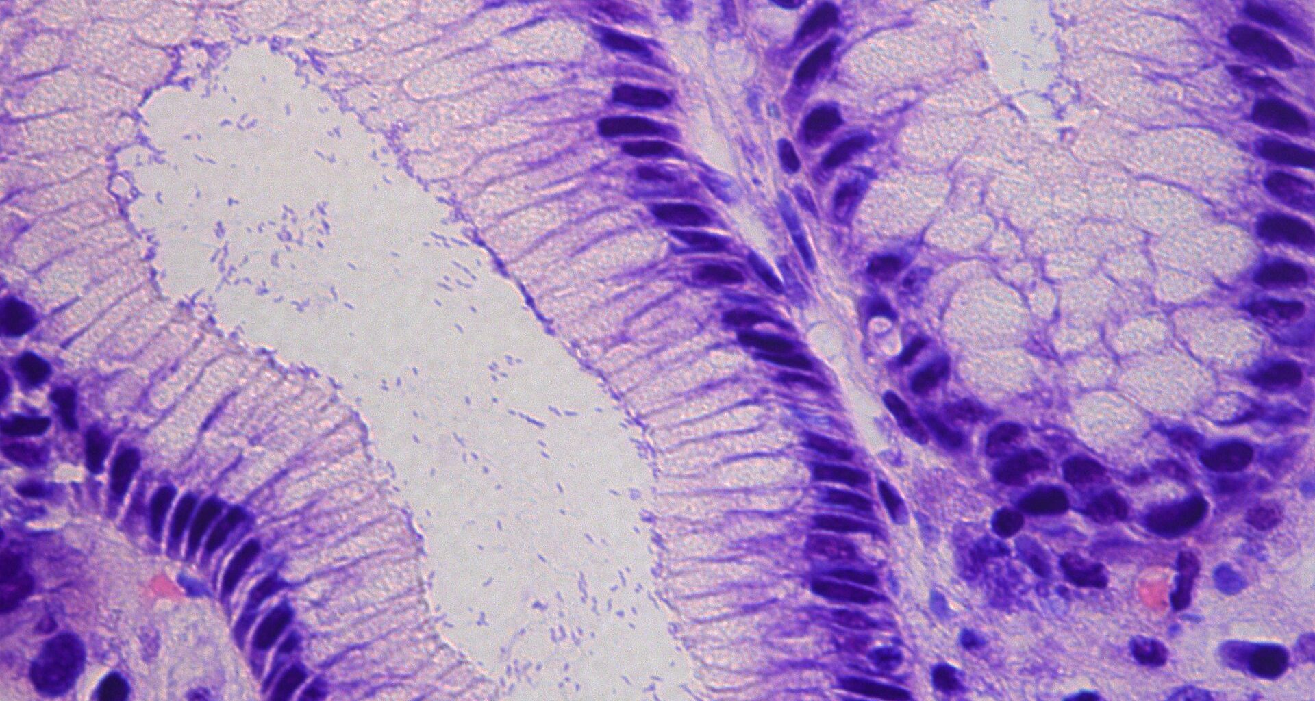 Hope For Preventing Stomach Cancer