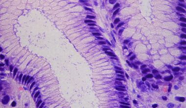 Hope For Preventing Stomach Cancer