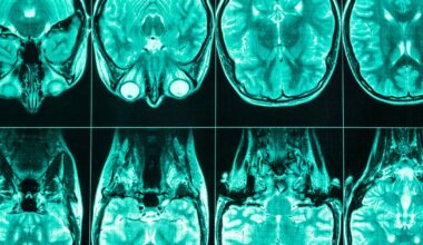 Insights from inside the MS brain