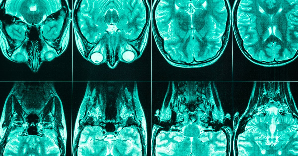 Insights from inside the MS brain