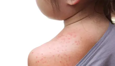 What you need to know about measles
