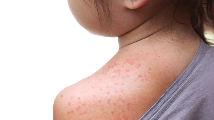 What you need to know about measles
