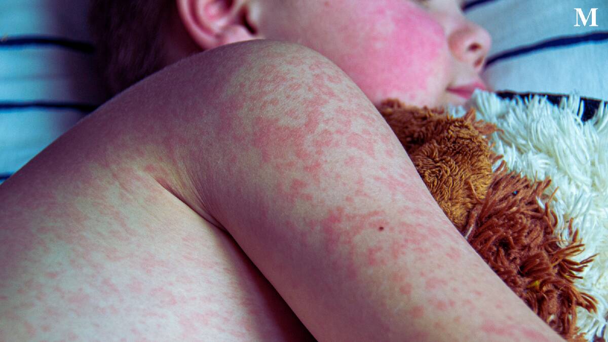 A child with a rash. Picture from Canva