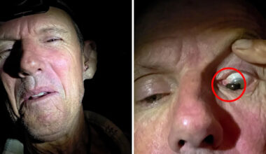 Man's two-hour ordeal after disturbing creature latches on to his eye