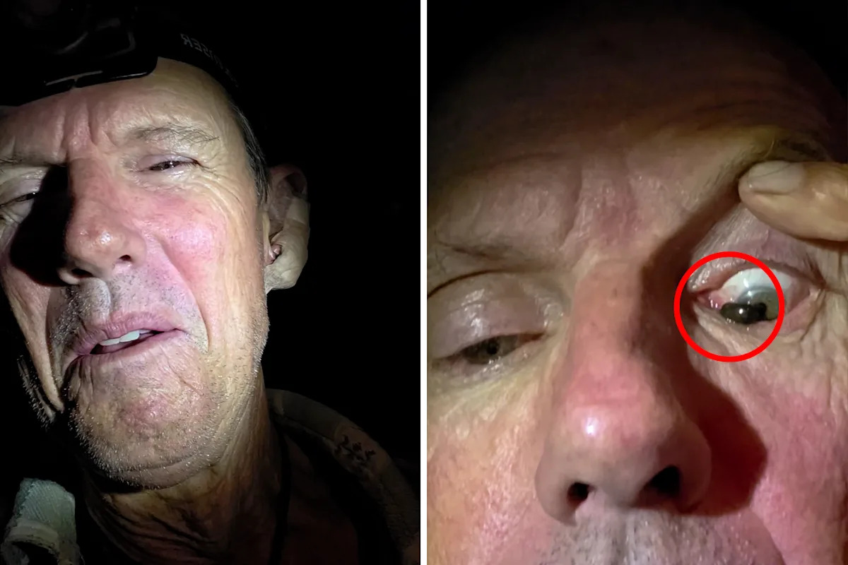 Man's two-hour ordeal after disturbing creature latches on to his eye