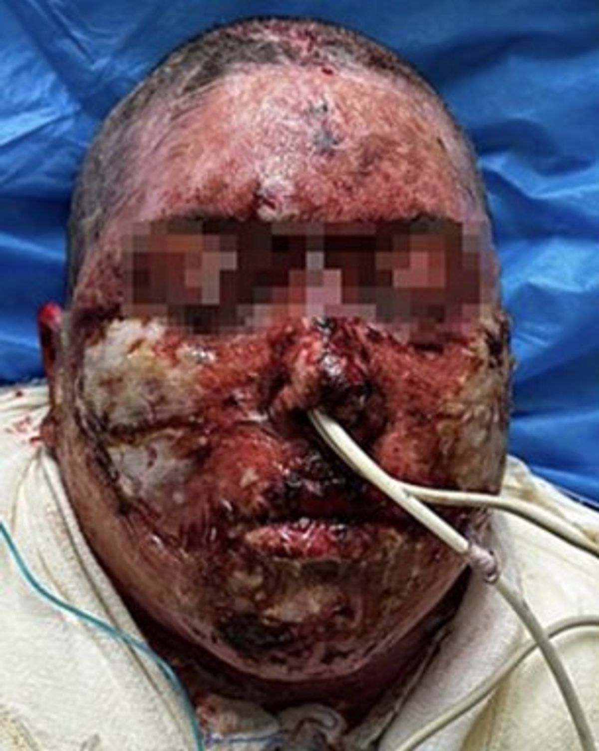 The woman four days after having bandages removed