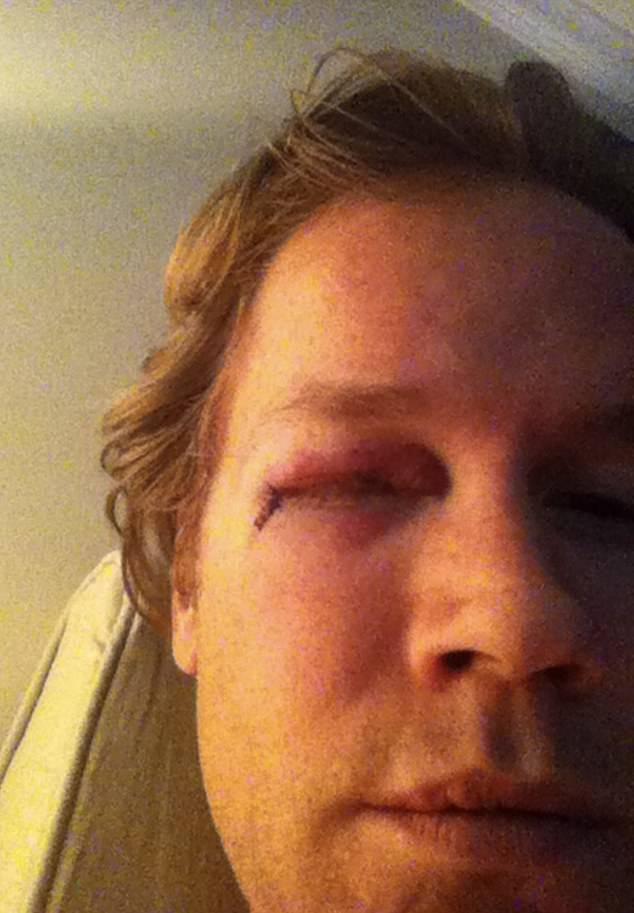 Pronger took a stick to his eye, resulting in hemorrhaging and initial fears of partial blindness