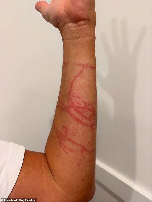 Pictured, Mr Rowles' forearm with angry red lines from the jellyfish's tentacles