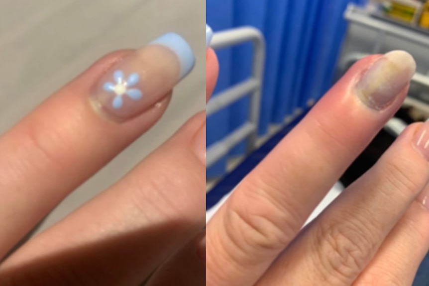 A composite picture of a woman's fingernail next to one of the same nail looking infected.