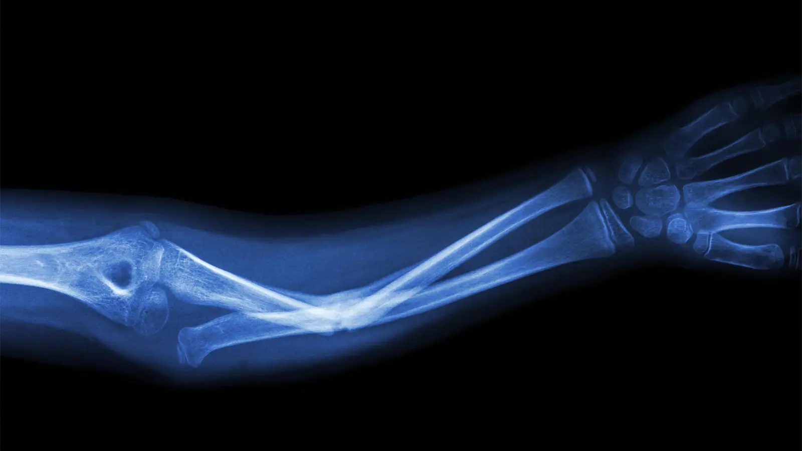 An x-ray image of an ulnar fracture.