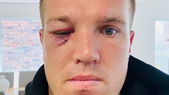 Jake Trbojevic’s right eye was still closed over on Sunday.
