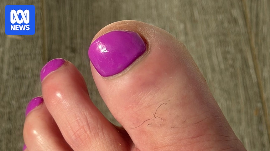 Perth women share experiences of infection and surgery after nail salon visits