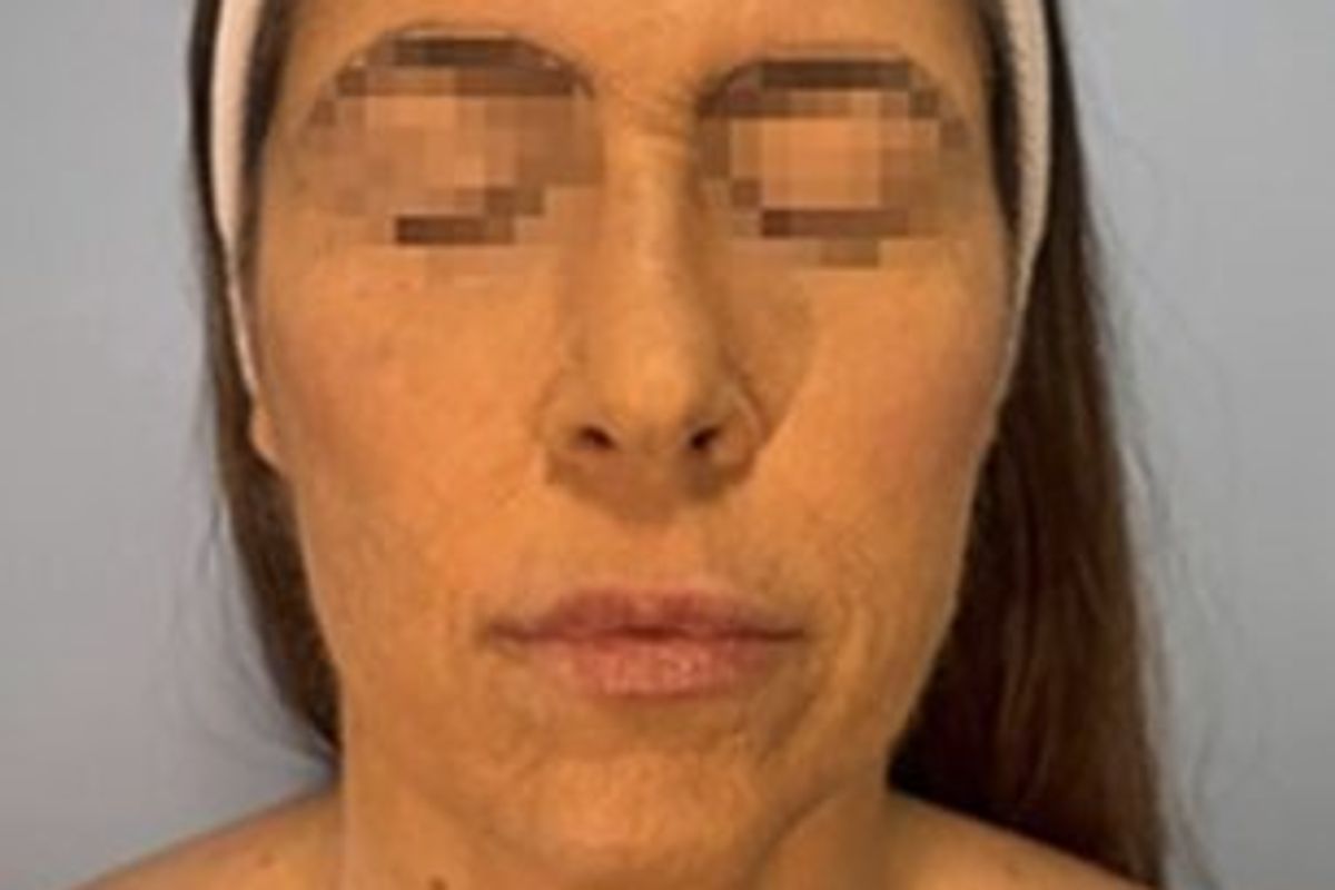 The reaction started with red blisters across her face