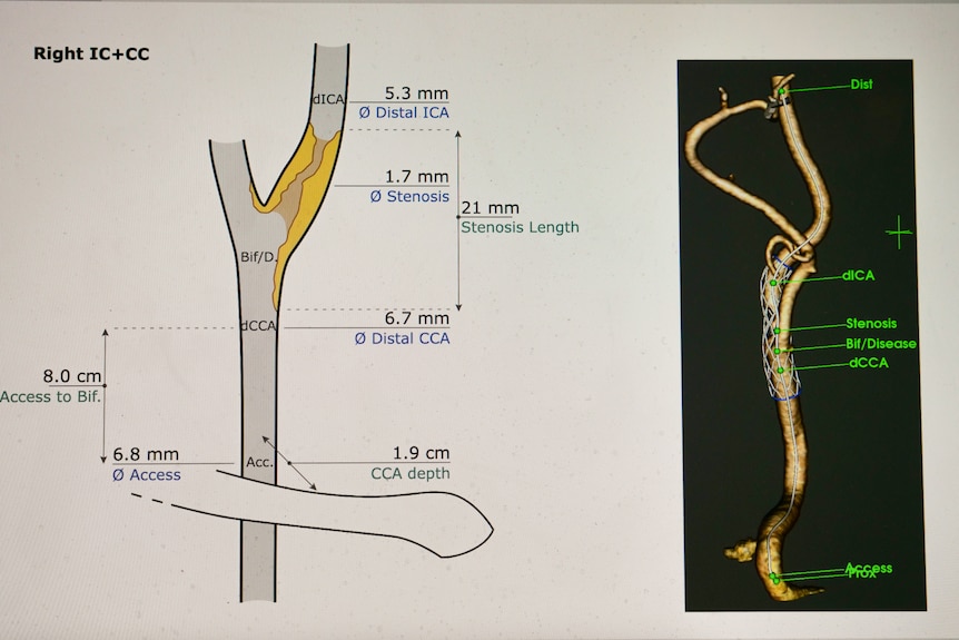 A computer screen with diagram of blocked artery