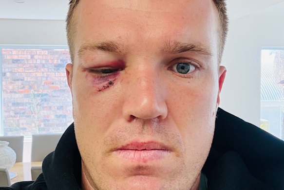 Jake Trbojevic’s right eye was still closed over on Sunday.