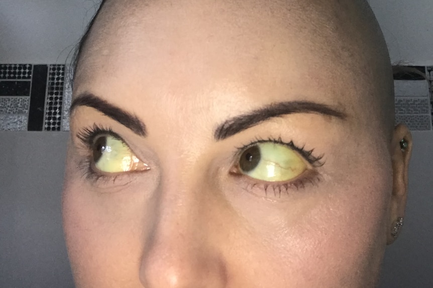 Close up of woman's eyes which are yellow