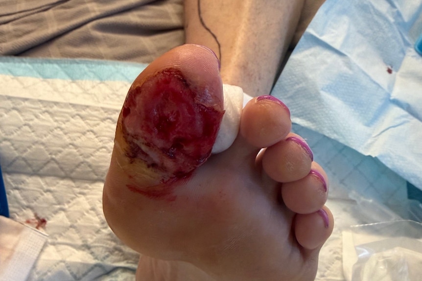 Underside of big toe, red and covered in blood