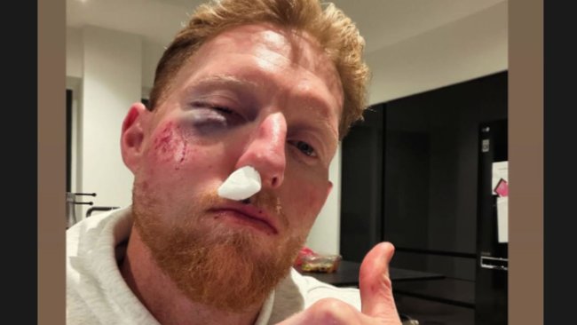 England cricket star Ben Stokes suffered severe facial injuries when he was struck by a cricket ball during a training session.