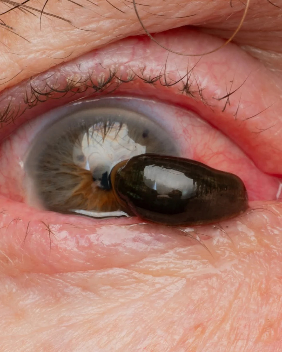 Extreme close-up of the leech in his eye.