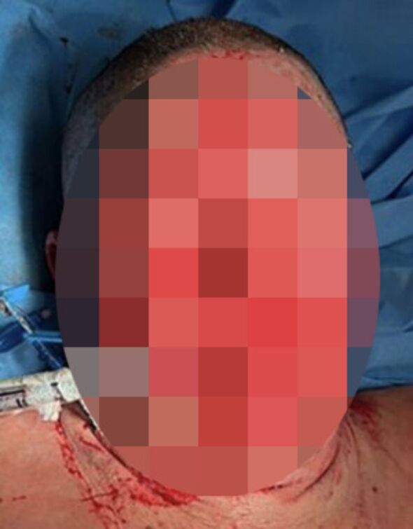 Woman’s FACE started burning off after rare reaction to depression medication