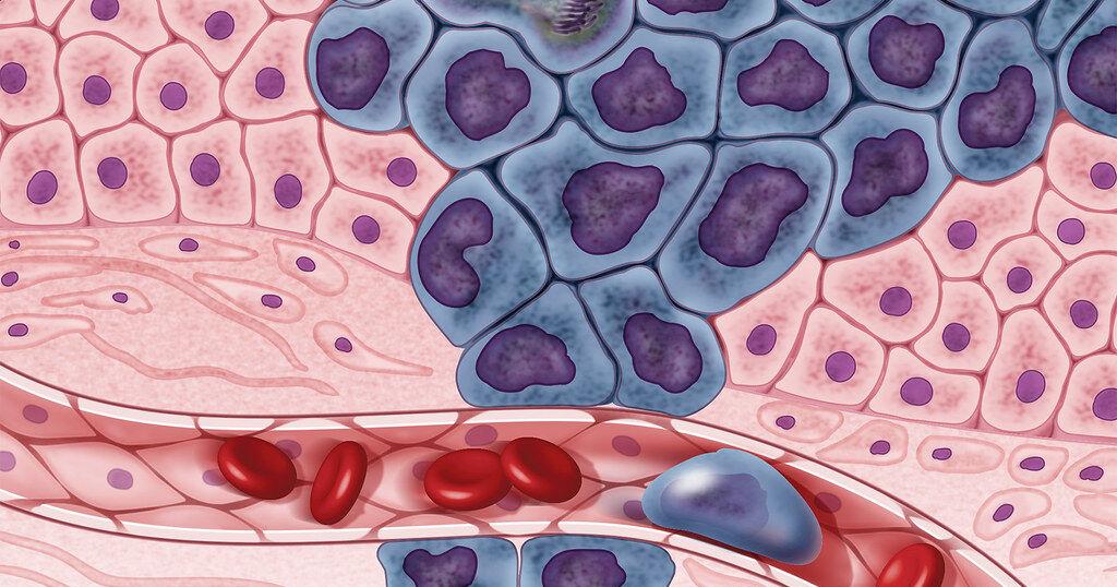 3D Printing to Fight Cancer? | Medical Manufacturing