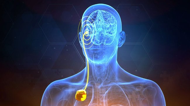 The electrodes are connected to a battery device implanted in the chest, similar to a heart pacemaker.
