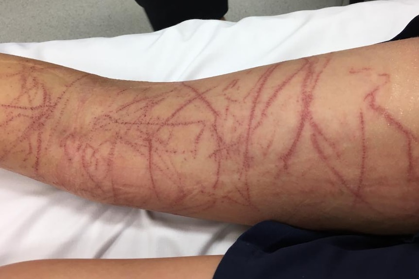 A leg covered in red jellyfish stings