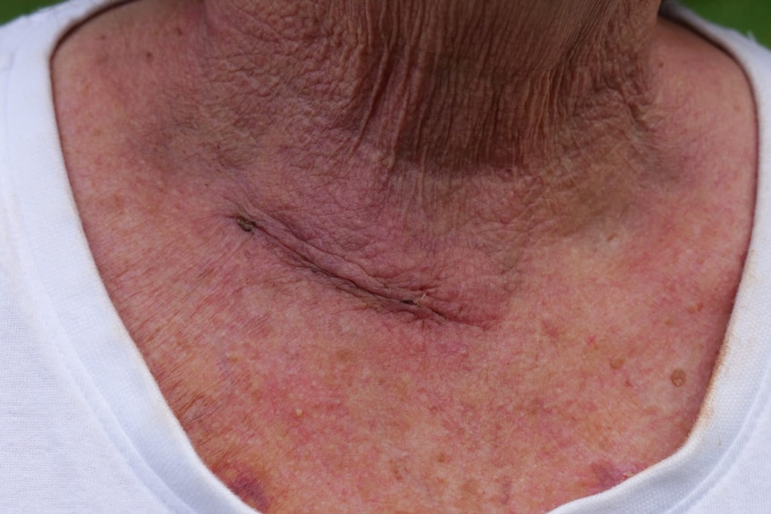 Close-up of recently healed scar, just above a lady's collarbone.