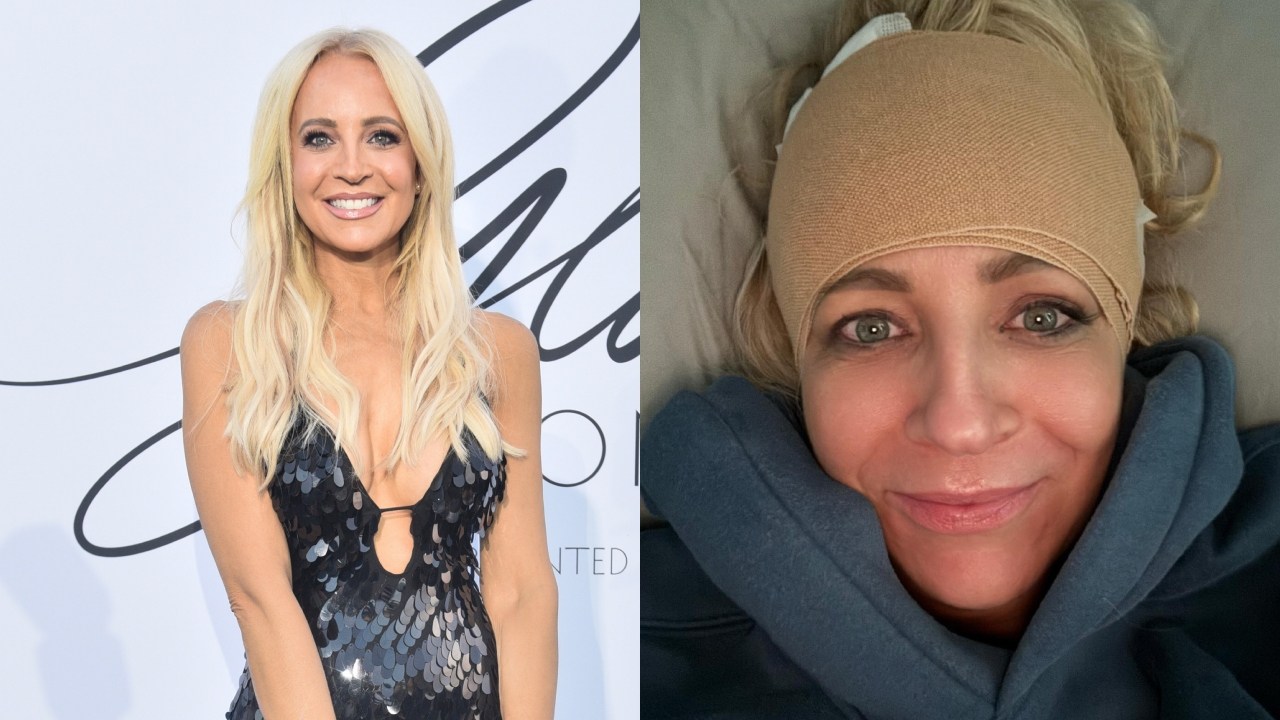'Blood spurting': Carrie Bickmore reveals gruesome head injury after walking into wall at home