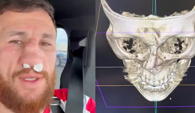 Merab Dvalishvili Suffers A Broken Nose
