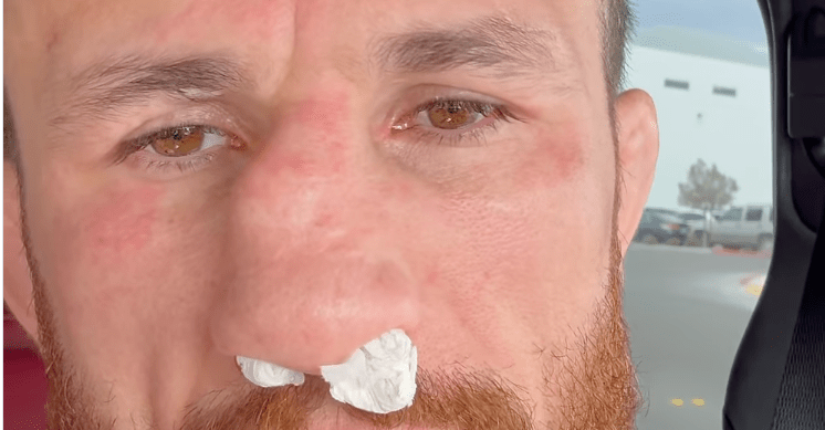 Merab Dvalishvili smashes nose in training, refusing surgery until retirement