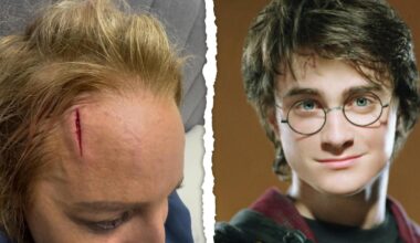 Carrie Bickmore: Radio and TV personality unveils nasty gash to her forehead drawing ‘Carrie Potter’ nickname