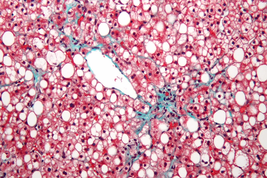 Micrograph of non-alcoholic fatty liver disease.