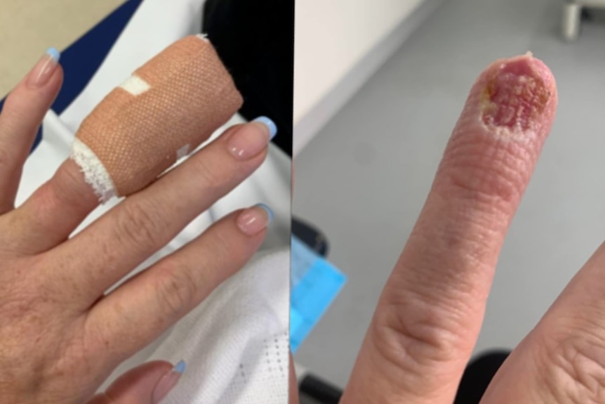 A composite picture of a woman's bandaged finger next to one of the same finger looking badly infected.