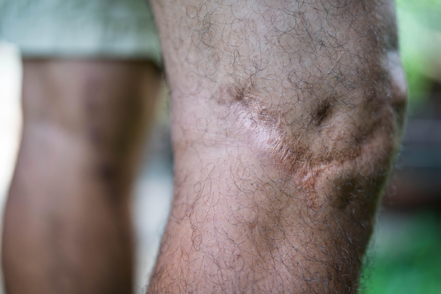 A close-up of a standing tan leg, scar that wraps around the knee in focus, other leg blurred in background