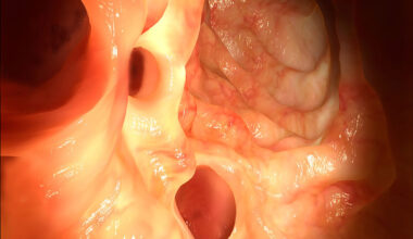 Diverticulitis up to 27% more common in summer or autumn than winter, Aussie review shows