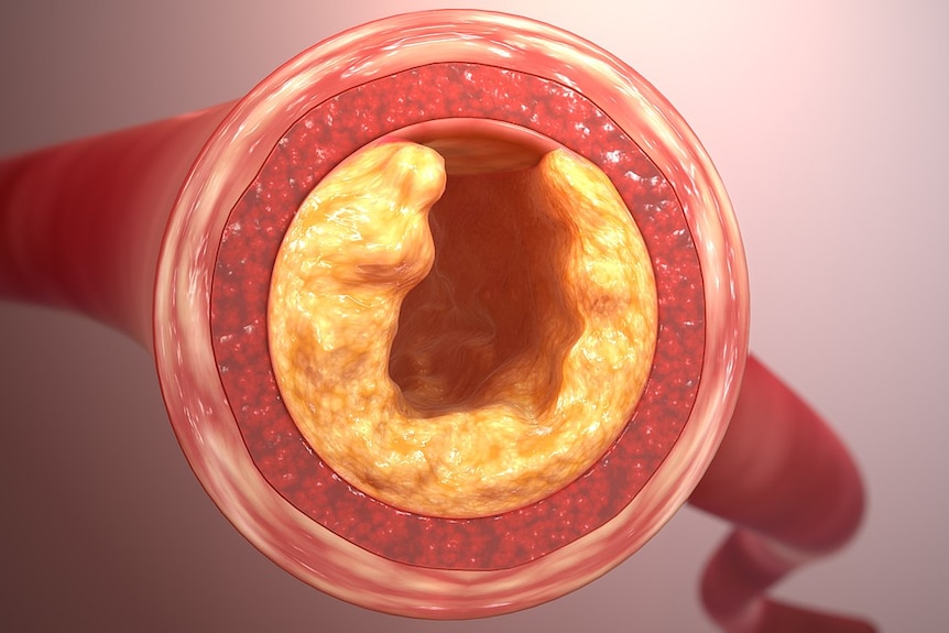 An illustration of plaque lining an artery.