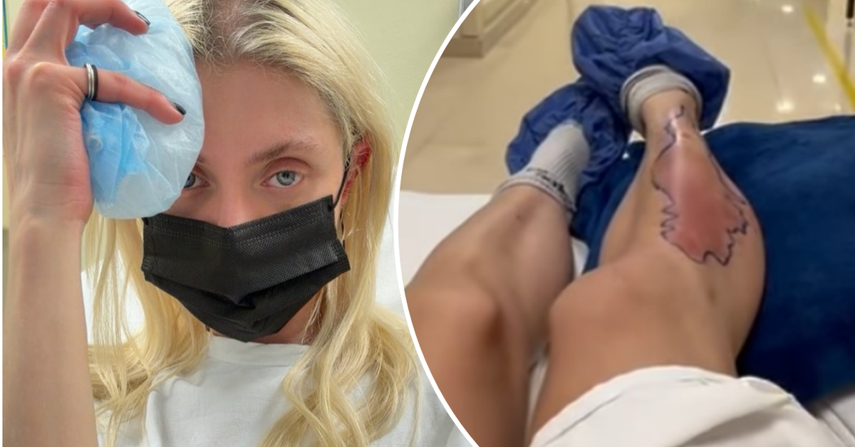 Taylor Momsen bitten by spider during mexico tour with AC/DC