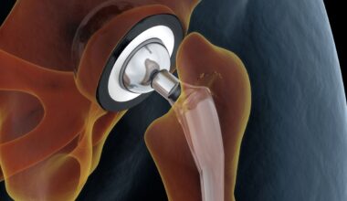 An illustration of a hip replacement is shown.