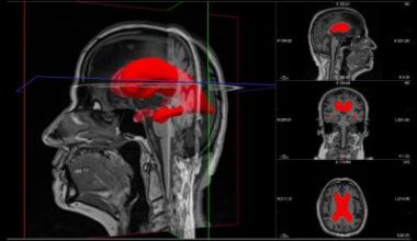 3D brain marker helps predict shunt surgery success • healthcare-in-europe.com