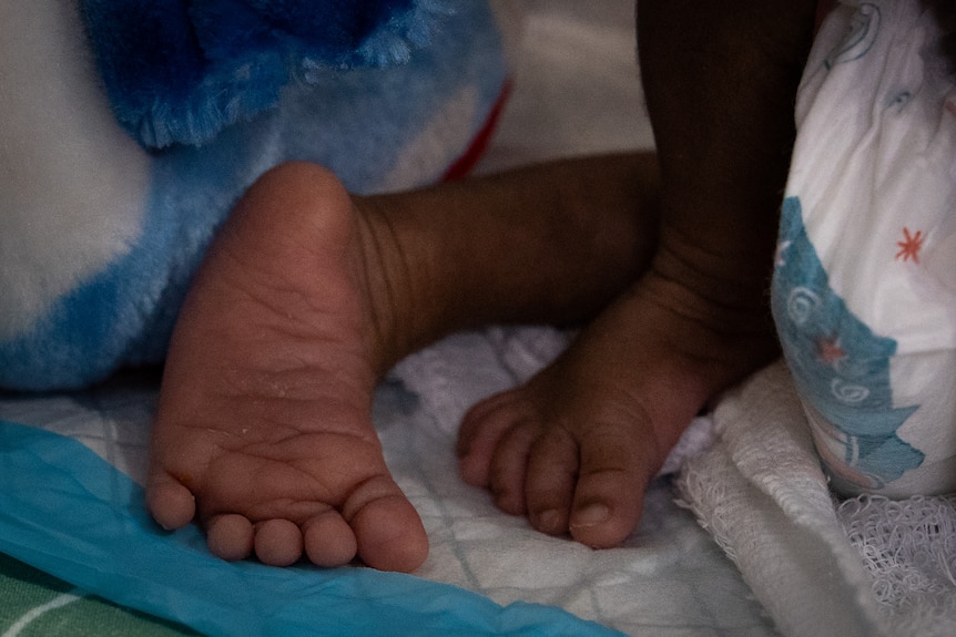 The legs of conjoined twins in a hospital bed.