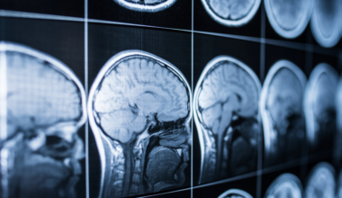 Ex-AFL player challenges league over concussion compensation