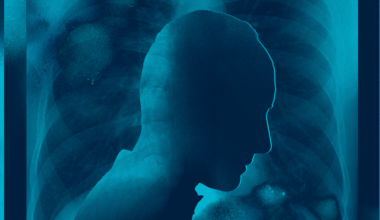 About Half of Patients with Metastatic Lung Cancer Don’t Get Treatment, Study Finds