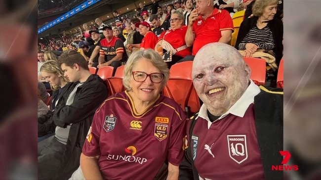 Dean Clifford has the skin condition Epidermolysis Bullosa (EB).